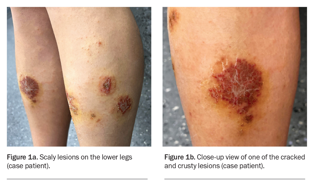 A woman with pruritic, scaly plaques on her legs Medicine Today
